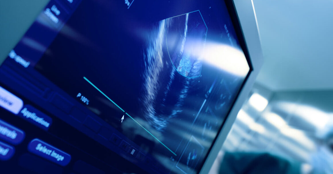 Seeing from Within: Why ICE is Reshaping the Future of Congenital Heart Interventions Image