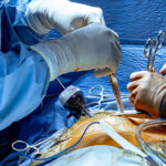 Reimagining Organ Preservation: How Machine Perfusion is Redefining Viability of Donor Organs Image